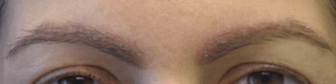 eyebrow transplant before and after result